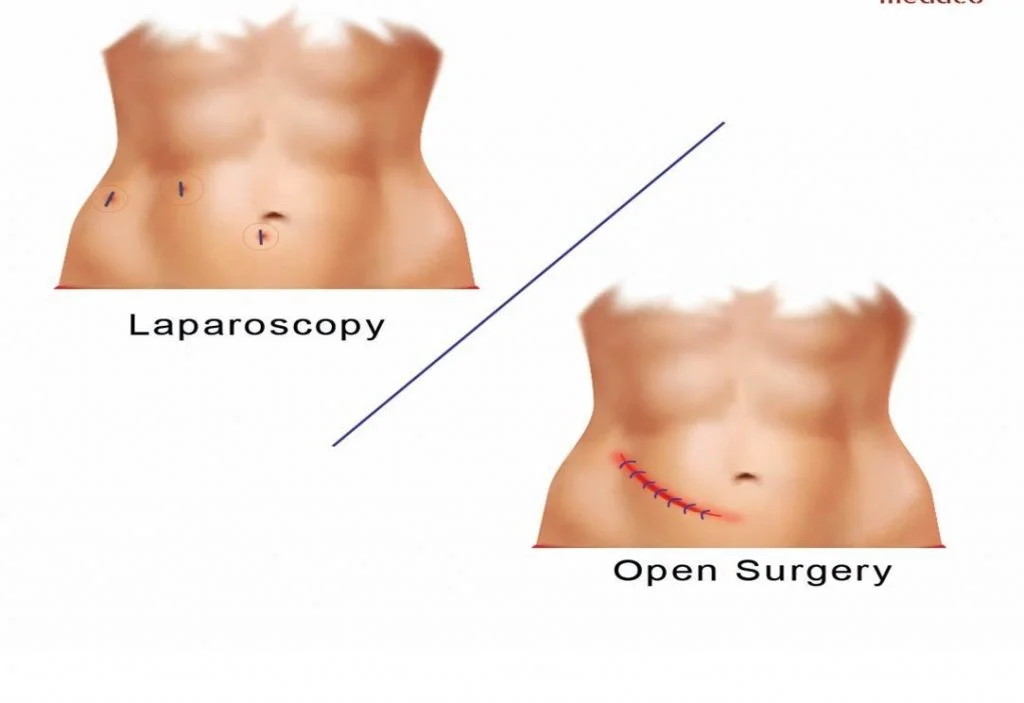 Laproscopy_new